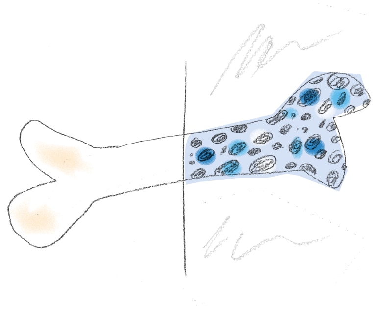 MS-News "Osteoporose bei MS"